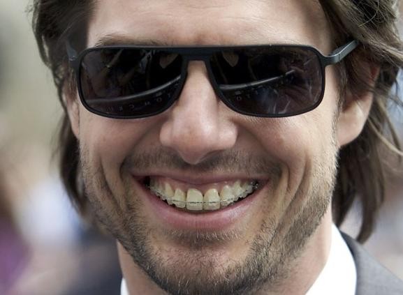Tom-Cruise-with-Braces