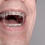 Orthodontic Treatment with Rubber Bands