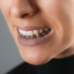 Can teeth shift back after braces?