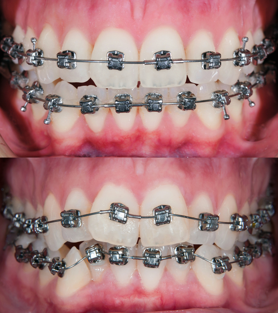 Before and after for orthodontic treatment