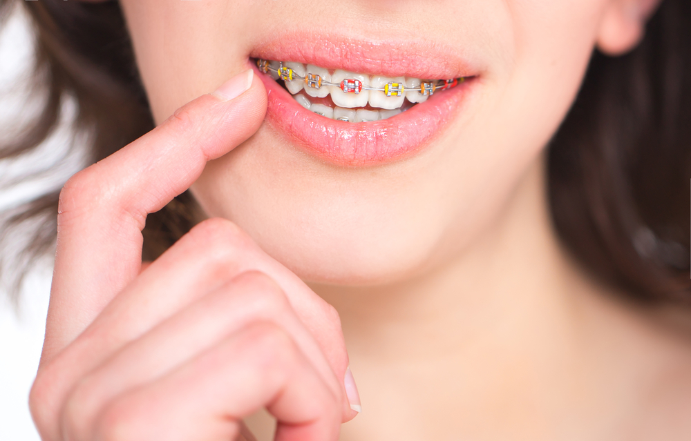 Tips to Pick the Best Colors for Your Braces