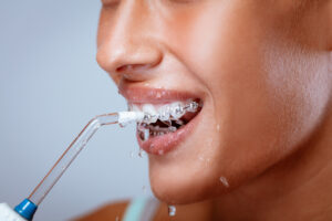 Waterpik Safe and Effective for Braces