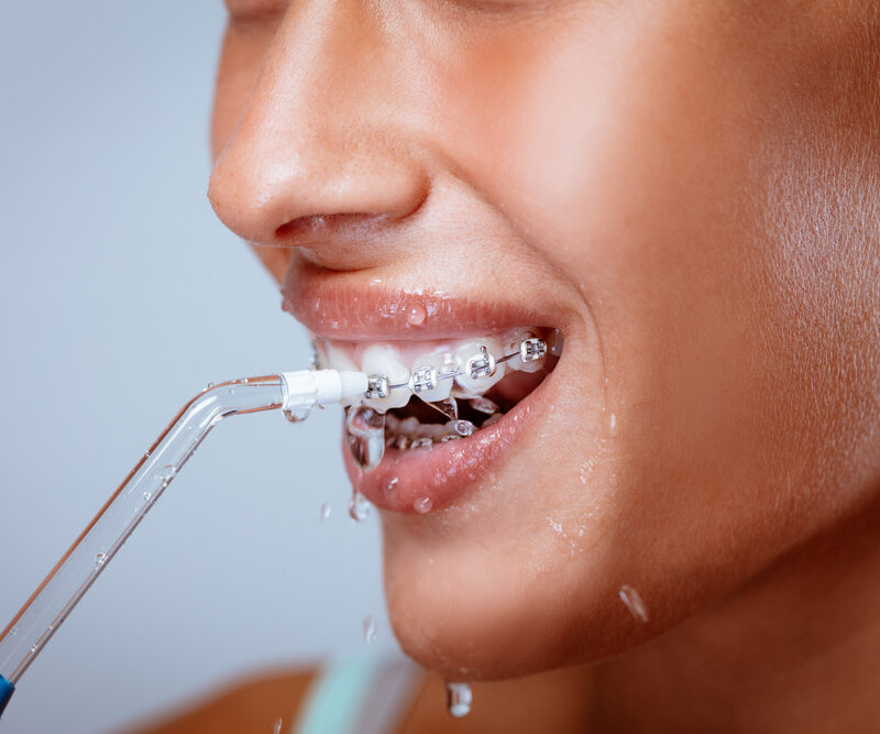 Waterpik Safe and Effective for Braces