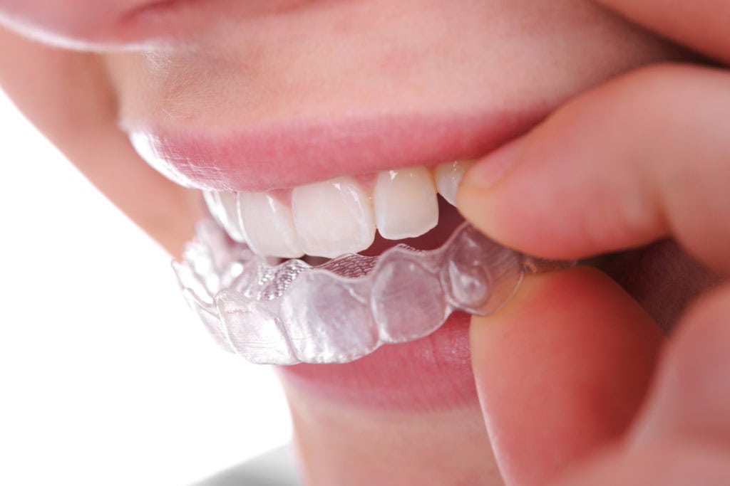 Invisalign clear aligners