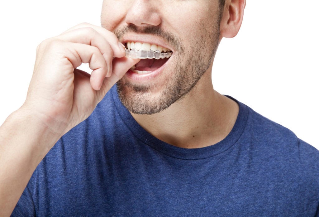 Invisalign clear aligners